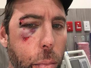 grant hacketts black eye